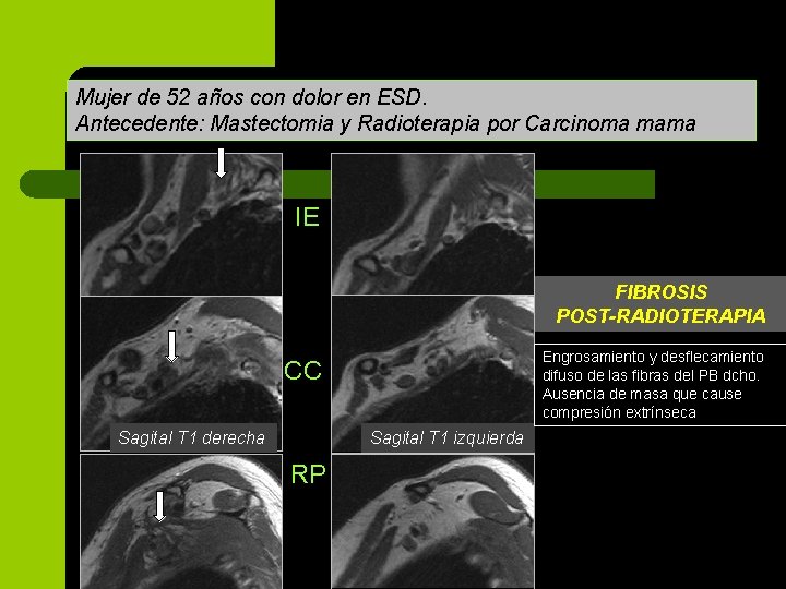 Izquierda Mujer de 52 años con dolor en ESD. Antecedente: Mastectomia y Radioterapia por