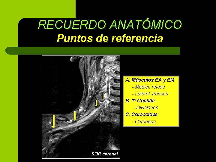 RECUERDO ANATÓMICO Puntos de referencia A. Músculos EA y EM: - Medial: raíces -