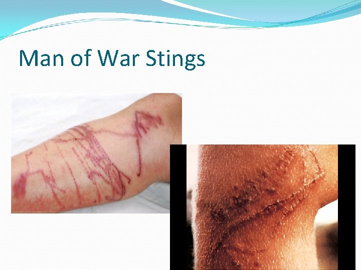 Man of War Stings 