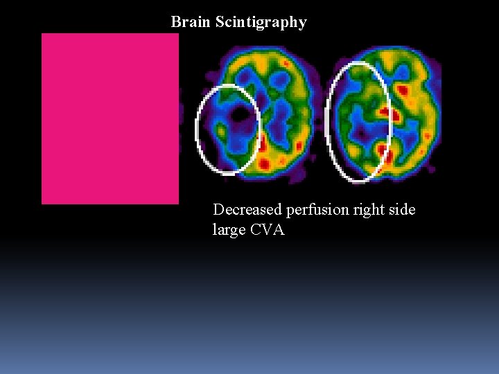Brain Scintigraphy Decreased perfusion right side large CVA 