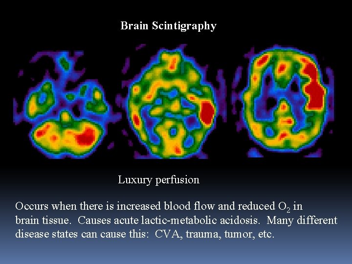 Brain Scintigraphy Luxury perfusion Occurs when there is increased blood flow and reduced O
