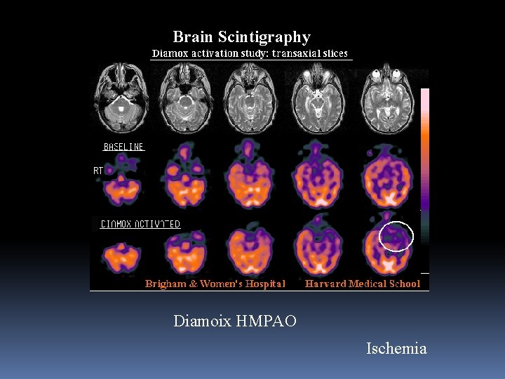 Brain Scintigraphy Diamoix HMPAO Ischemia 