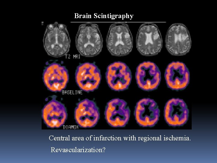 Brain Scintigraphy Central area of infarction with regional ischemia. Revascularization? 