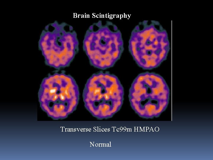 Brain Scintigraphy Transverse Slices Tc 99 m HMPAO Normal 