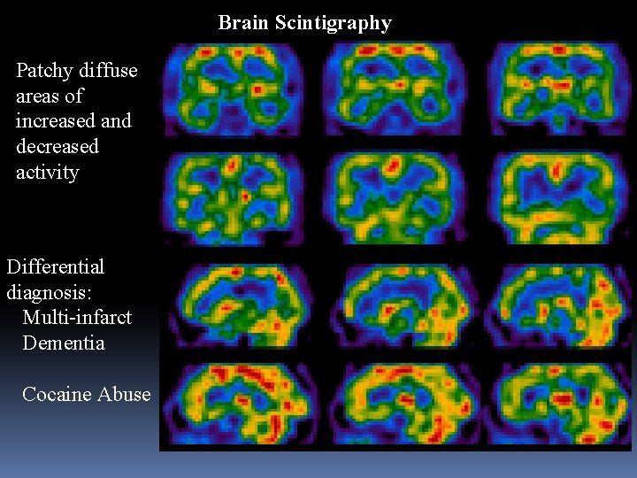 Brain Scintigraphy Patchy diffuse areas of increased and decreased activity Differential diagnosis: Multi-infarct Dementia