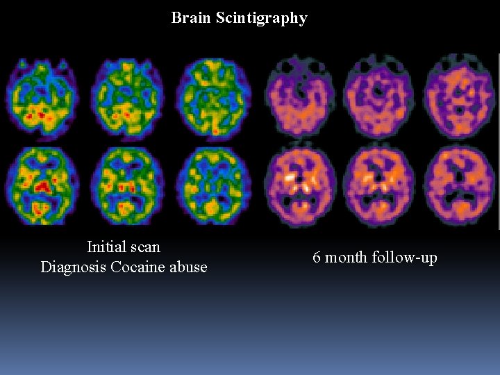 Brain Scintigraphy Initial scan Diagnosis Cocaine abuse 6 month follow-up 