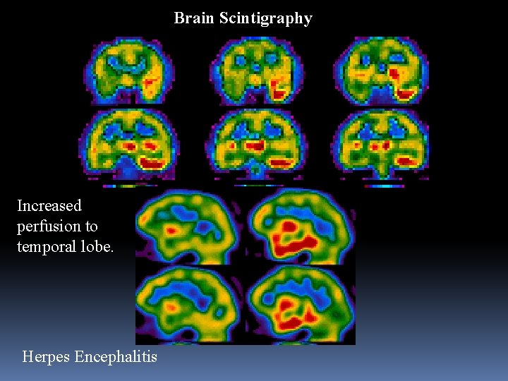 Brain Scintigraphy Increased perfusion to temporal lobe. Herpes Encephalitis 