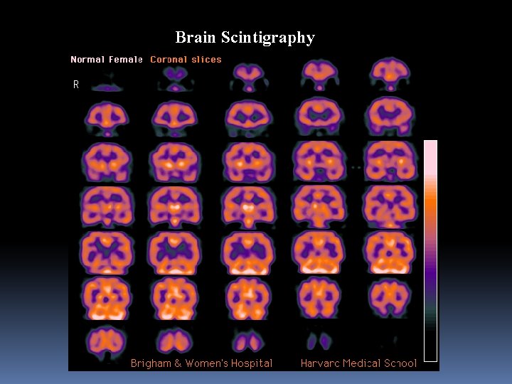 Brain Scintigraphy 