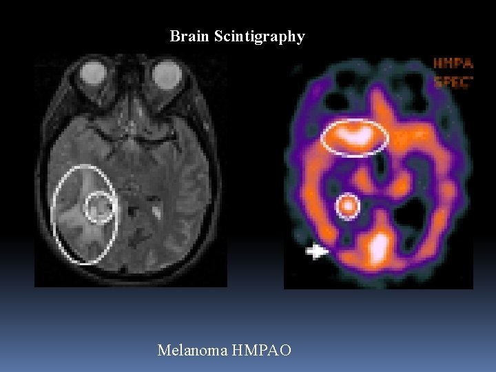 Brain Scintigraphy Melanoma HMPAO 