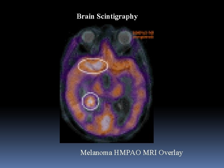 Brain Scintigraphy Melanoma HMPAO MRI Overlay 