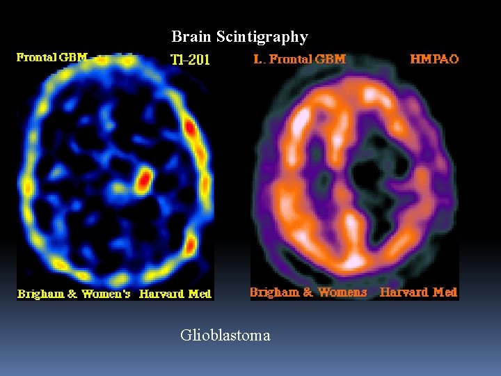 Brain Scintigraphy Glioblastoma 