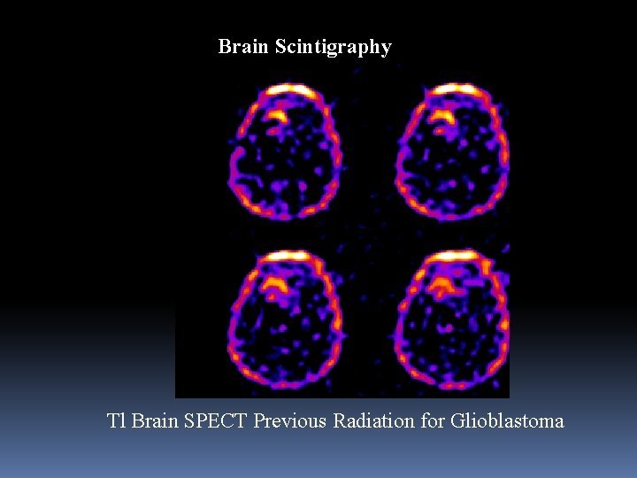 Brain Scintigraphy Tl Brain SPECT Previous Radiation for Glioblastoma 