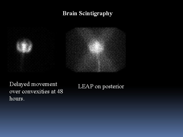 Brain Scintigraphy Delayed movement over convexities at 48 hours. LEAP on posterior 