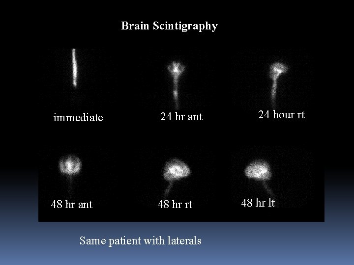 Brain Scintigraphy immediate 24 hr ant 48 hr rt Same patient with laterals 24