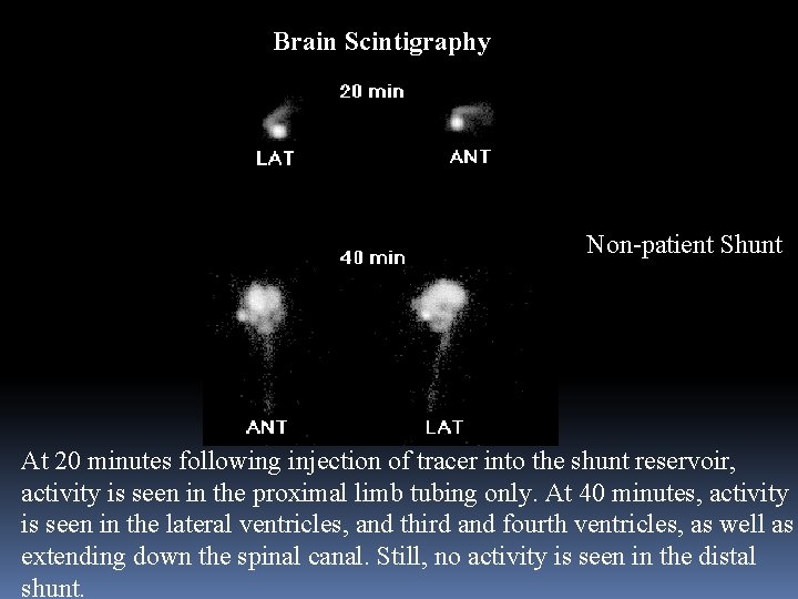 Brain Scintigraphy Non-patient Shunt At 20 minutes following injection of tracer into the shunt
