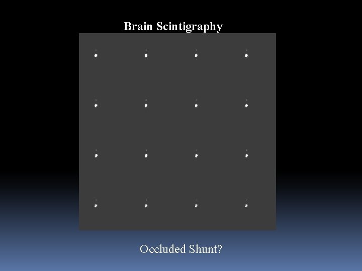 Brain Scintigraphy Occluded Shunt? 