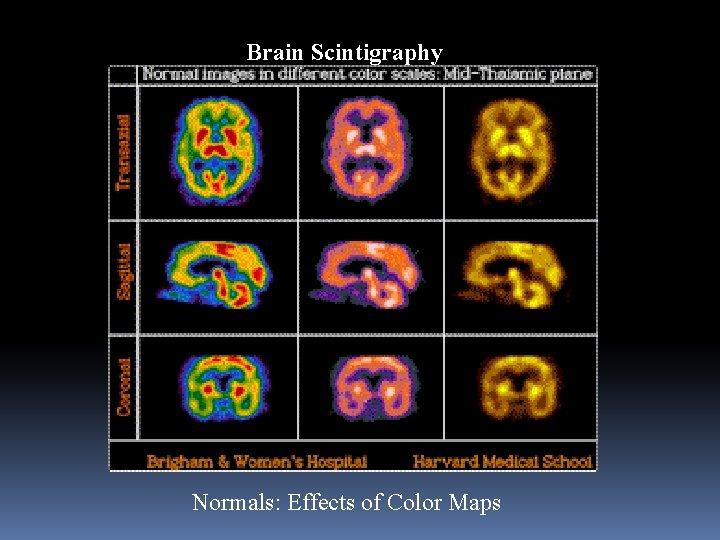 Brain Scintigraphy Normals: Effects of Color Maps 