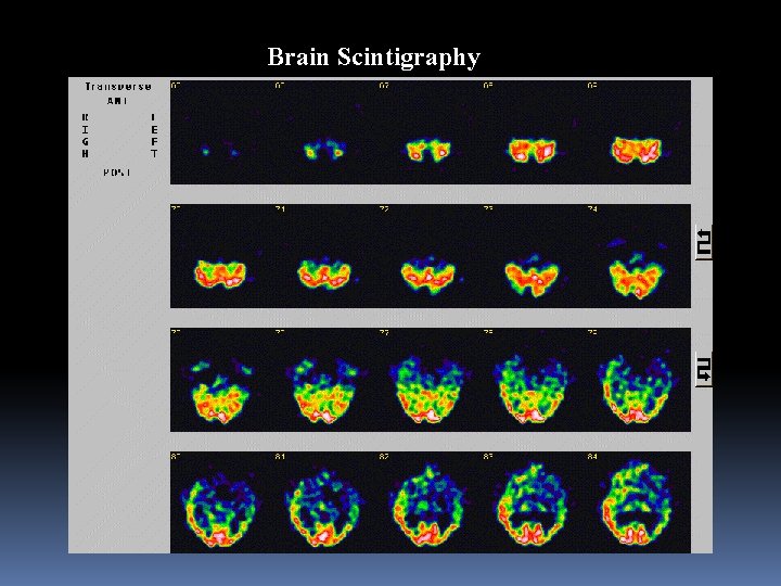 Brain Scintigraphy 