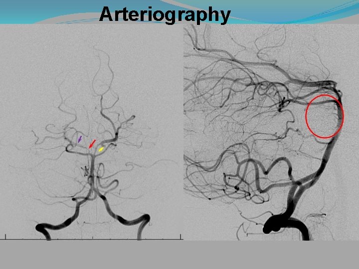 Arteriography 