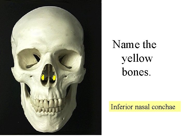 Name the yellow bones. Inferior nasal conchae 