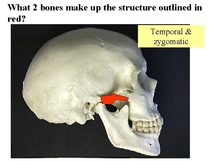 What 2 bones make up the structure outlined in red? Temporal & zygomatic 