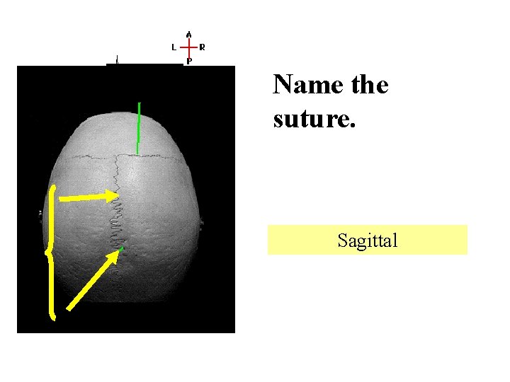 Name the suture. Sagittal 