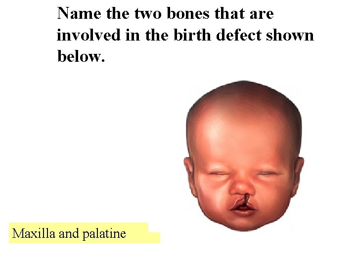 Name the two bones that are involved in the birth defect shown below. Maxilla