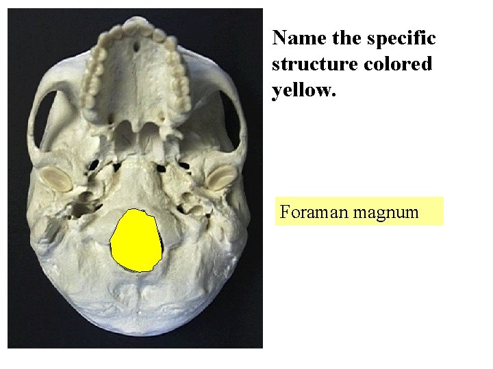 Name the specific structure colored yellow. Foraman magnum 