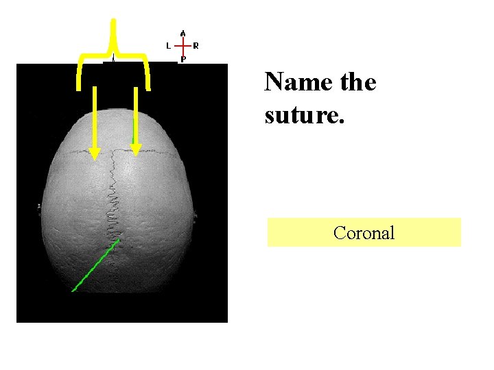 Name the suture. Coronal 