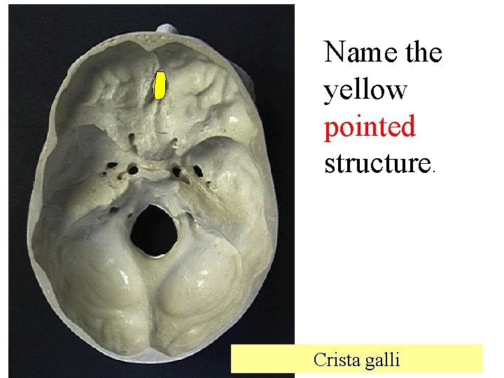Name the yellow pointed structure. Crista galli 