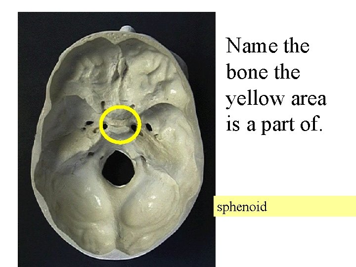 Name the bone the yellow area is a part of. sphenoid 