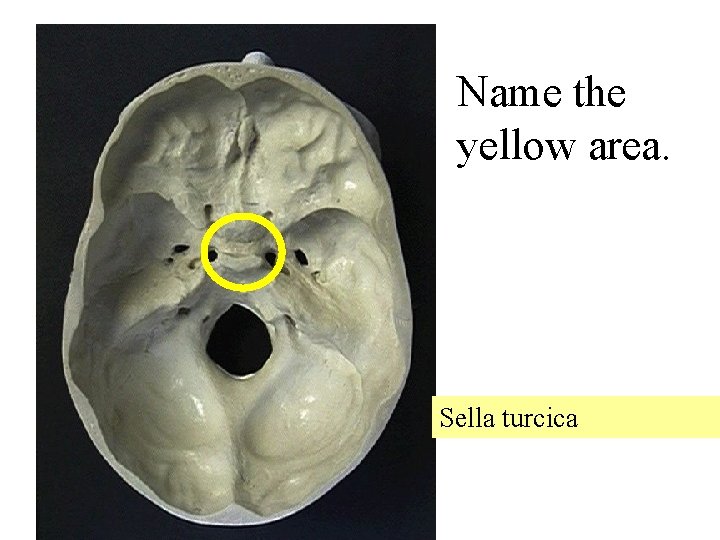 Name the yellow area. Sella turcica 