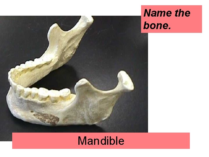 Name the bone. Mandible 