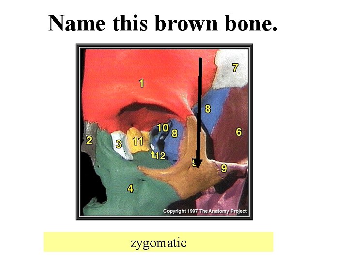 Name this brown bone. zygomatic 