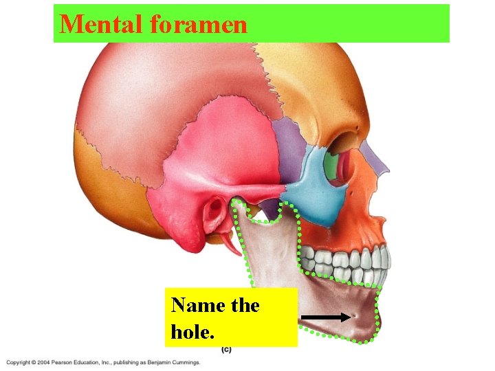 Mental foramen Name the hole. 