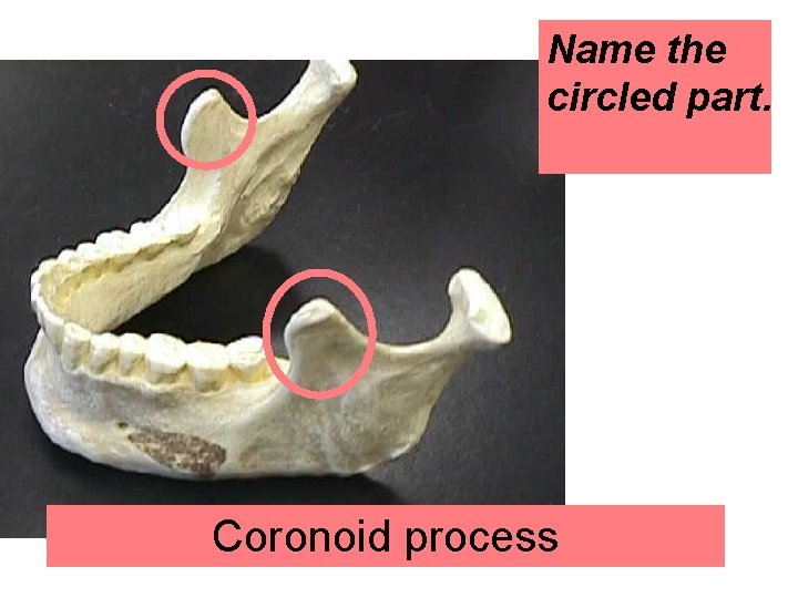 Name the circled part. Coronoid process 