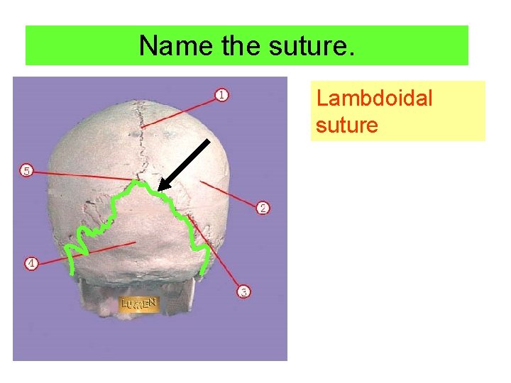 Name the suture. Lambdoidal suture 