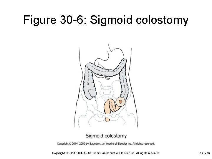 Figure 30 -6: Sigmoid colostomy Copyright © 2014, 2009 by Saunders, an imprint of