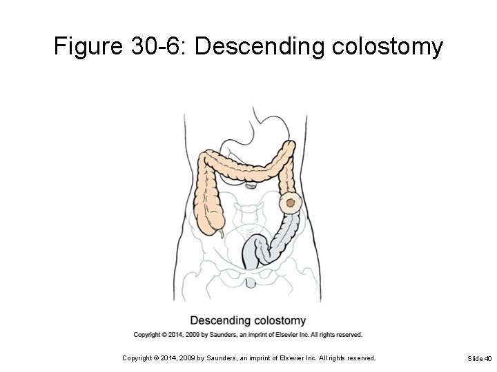 Figure 30 -6: Descending colostomy Copyright © 2014, 2009 by Saunders, an imprint of