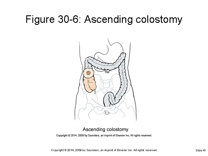 Figure 30 -6: Ascending colostomy Copyright © 2014, 2009 by Saunders, an imprint of