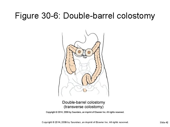 Figure 30 -6: Double-barrel colostomy Copyright © 2014, 2009 by Saunders, an imprint of