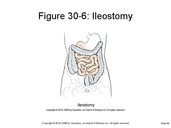 Figure 30 -6: Ileostomy Copyright © 2014, 2009 by Saunders, an imprint of Elsevier