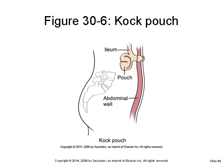 Figure 30 -6: Kock pouch Copyright © 2014, 2009 by Saunders, an imprint of