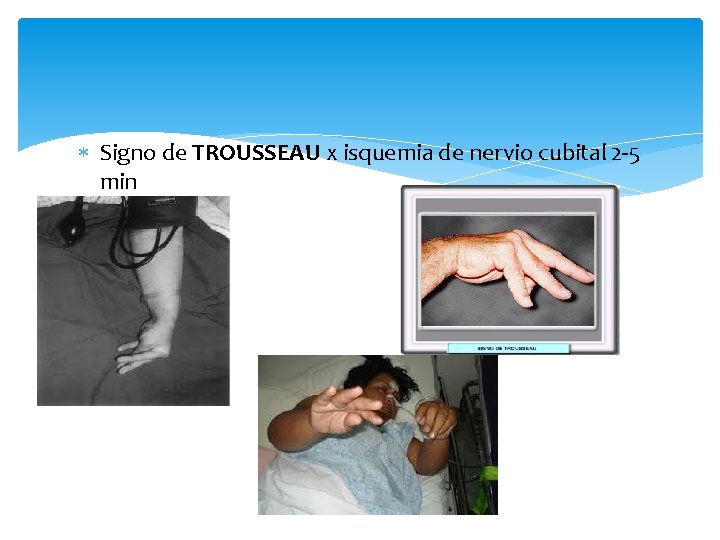  Signo de TROUSSEAU x isquemia de nervio cubital 2 -5 min 