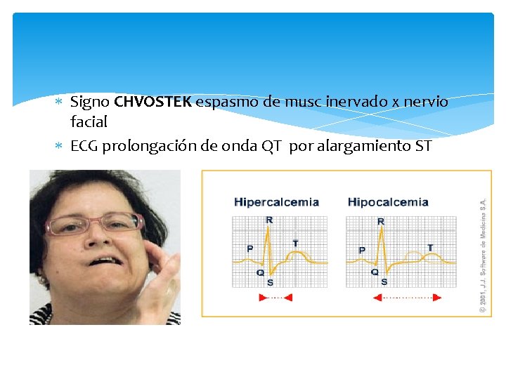  Signo CHVOSTEK espasmo de musc inervado x nervio facial ECG prolongación de onda