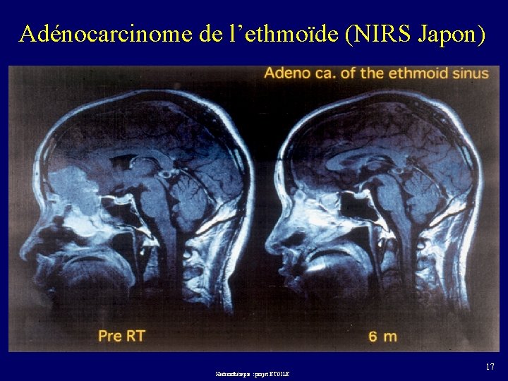 Adénocarcinome de l’ethmoïde (NIRS Japon) Hadronthérapie : projet ETOILE 17 