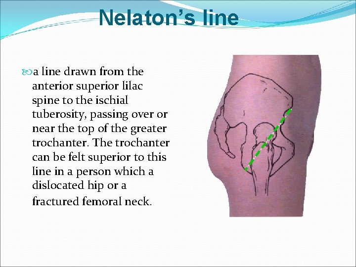 Nelaton’s line a line drawn from the anterior superior lilac spine to the ischial