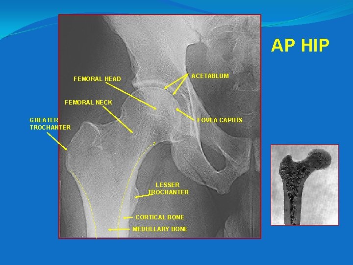 AP HIP ACETABLUM FEMORAL HEAD FEMORAL NECK GREATER TROCHANTER FOVEA CAPITIS LESSER TROCHANTER CORTICAL