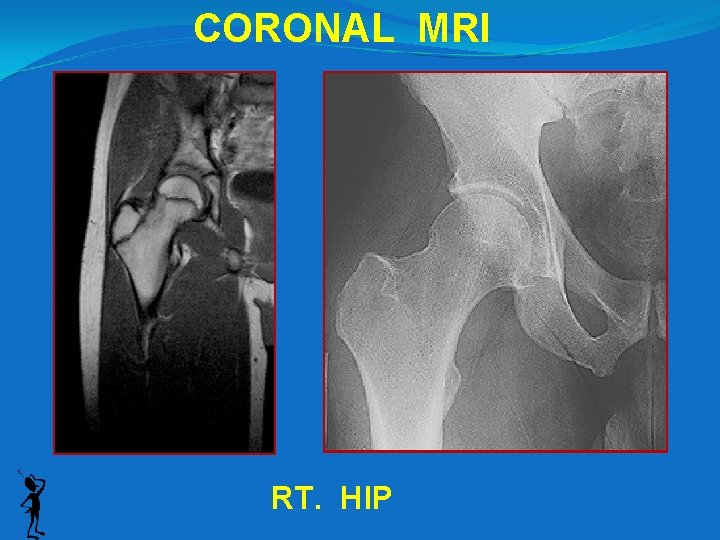 CORONAL MRI RT. HIP 