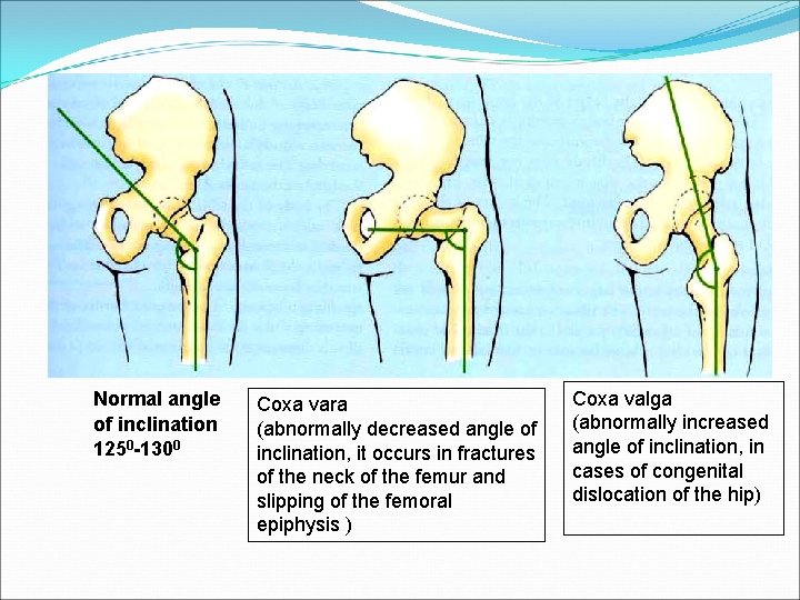 Normal angle of inclination 1250 -1300 Coxa vara (abnormally decreased angle of inclination, it